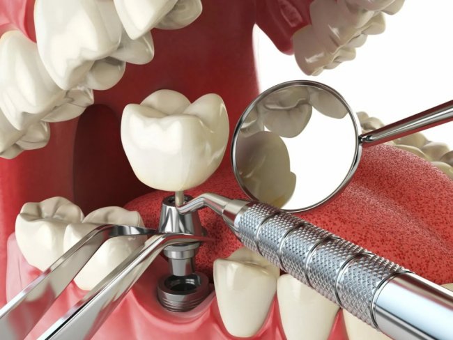 Amazon travel Dental Implant Treatment